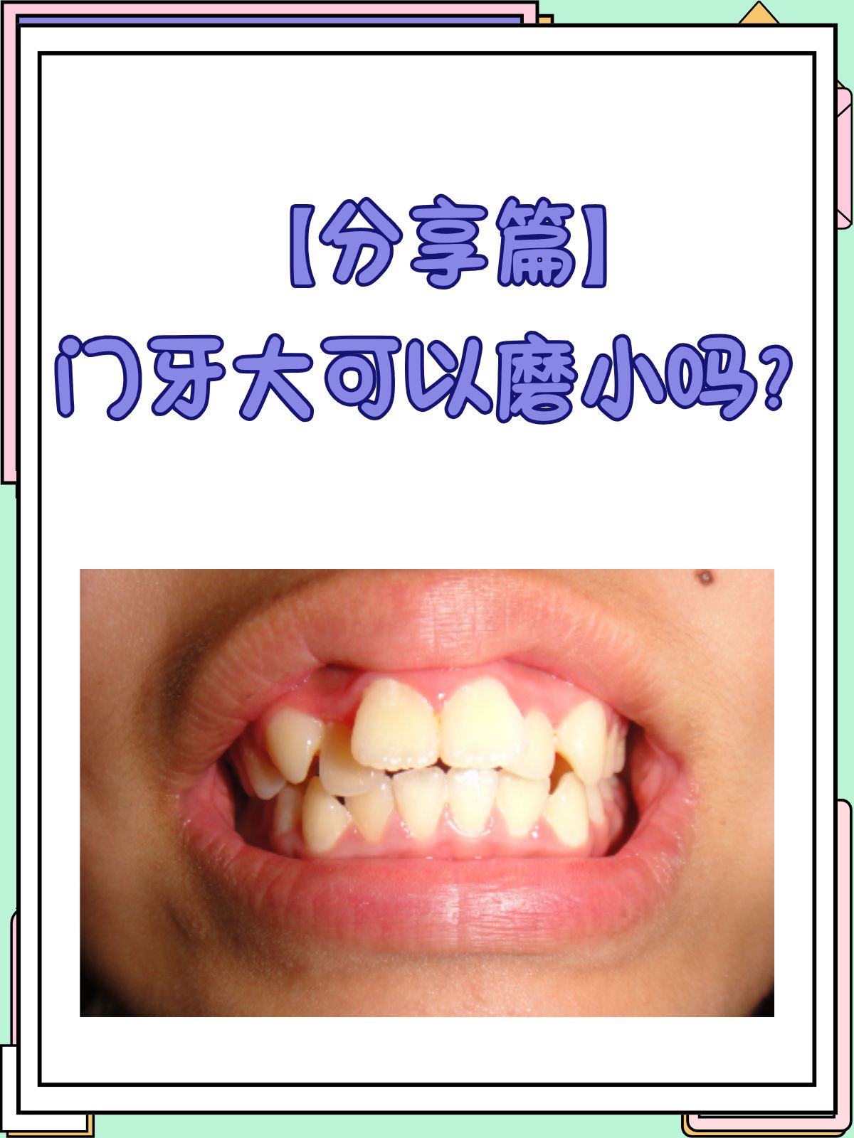 🌟最新大门牙，璀璨闪耀提升你的笑容魅力💖